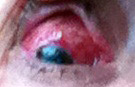 Eye Injury